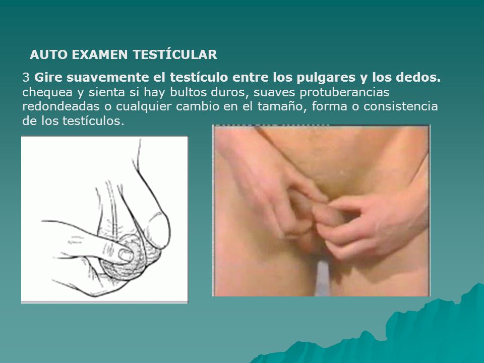 Bulto en testiculo derecho